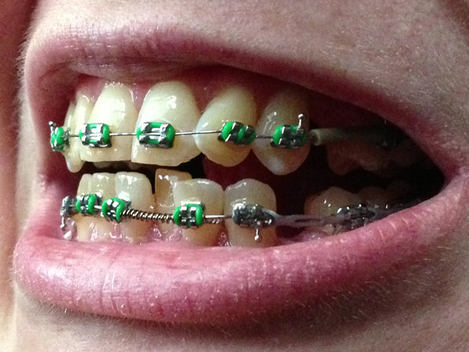 bonkers smith recommends can you give blowjob with braces pic