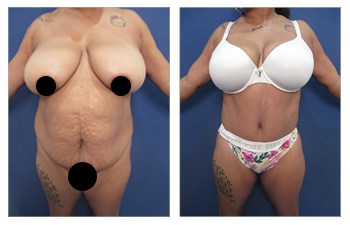 Bbw With Breast Implants yza ruhelwo