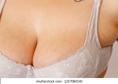 alex kovalchuk recommends tits with stretch marks pic