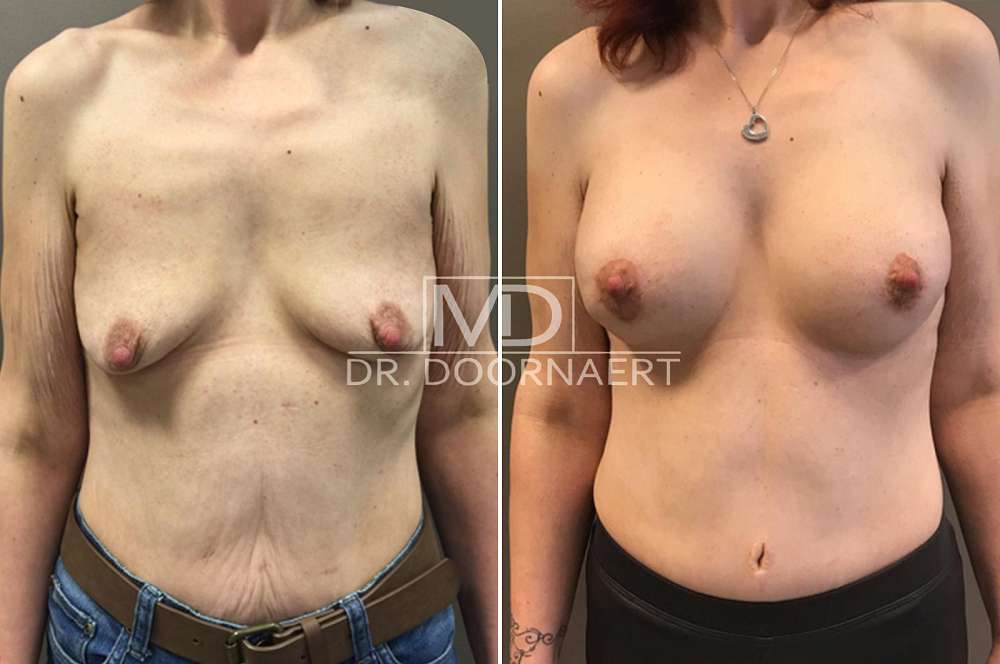 Forced Breast Expansion higareda penetrada